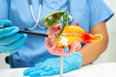 Diabetes repentina após os 50 anos pode sinalizar câncer de pâncreas